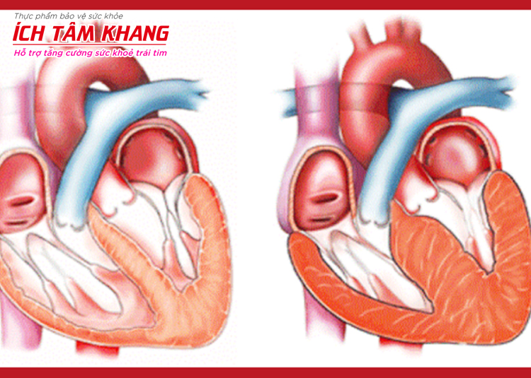 Bệnh cơ tim phì đại là bệnh phổ biến nhất trong nhóm bệnh cơ tim
